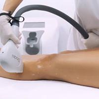 Primelase hair removal treatment Primelase hair removal treatment